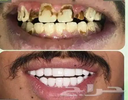 هوليود سمايل 6