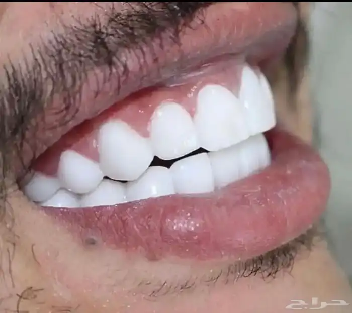 عروض رمضان على ابتسامة هوليود المتحركه يوجد اقساط 1