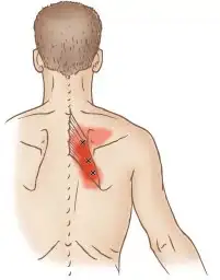 جلسات علاج الابهر والم اسفل الظهر وعرق النسا 8