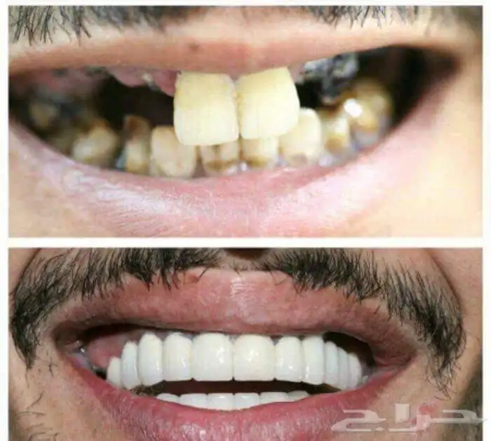 هوليود سمايل المتحرك 11