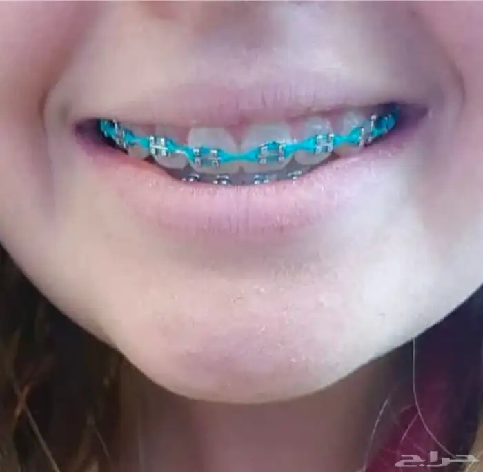 تقويم أسنان زينه 0