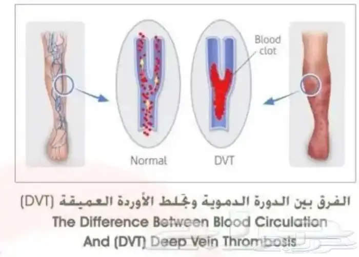 جهاز مانع تجلطات الدم في الأقدام 0