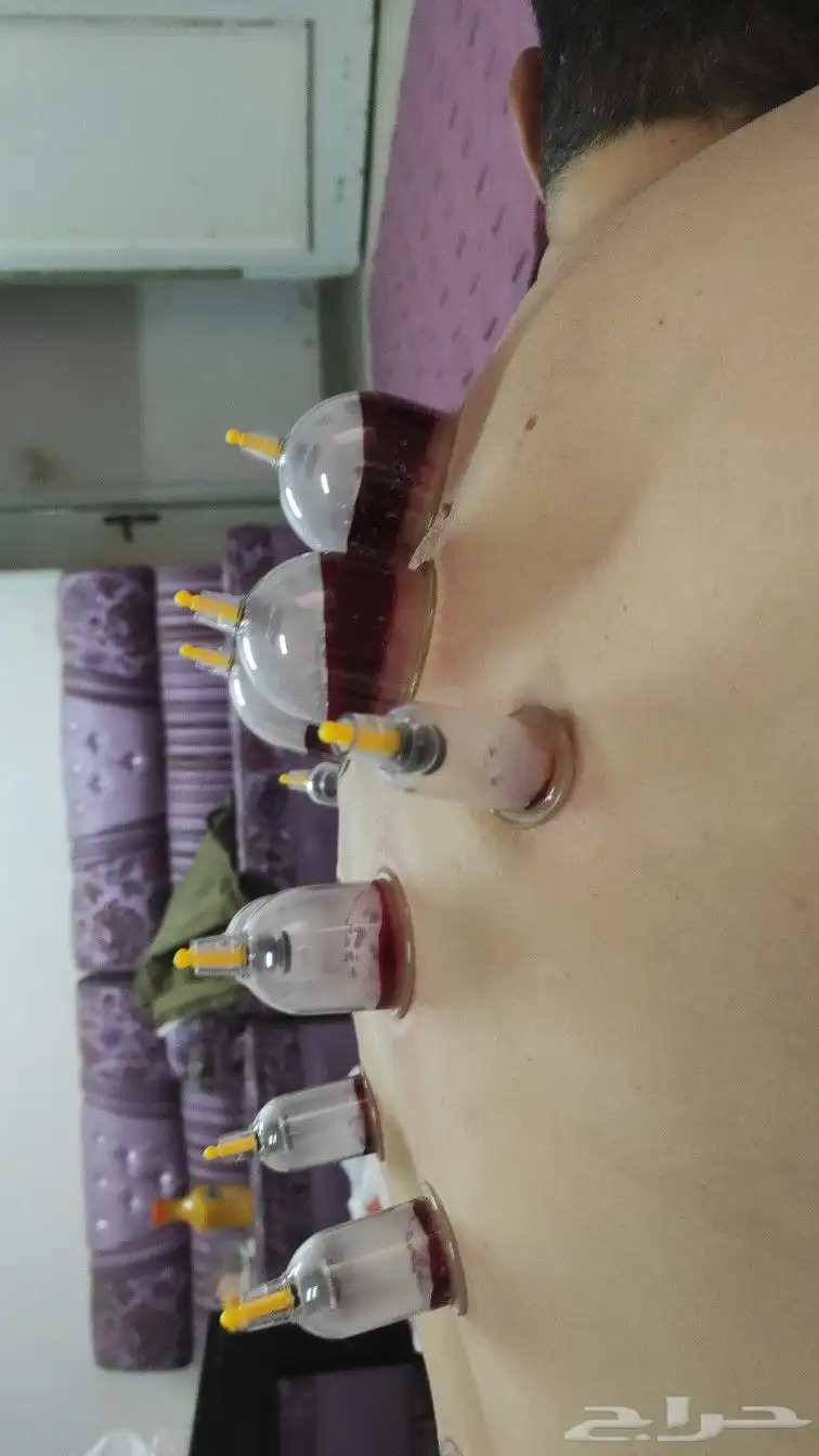 اخصائي حجامه زيارات منزليه 9
