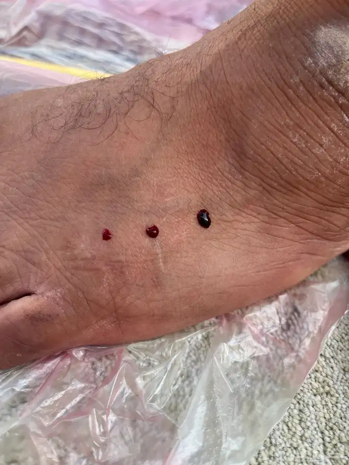 فصد عرق النسا والآم الظهر 1