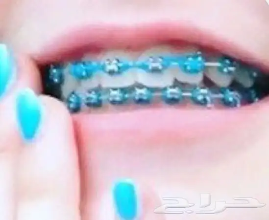 تقويم أسنان زينه 0