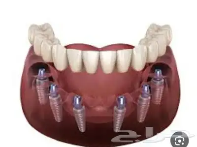 لايفوتك عروض زراعة الأسنان 0