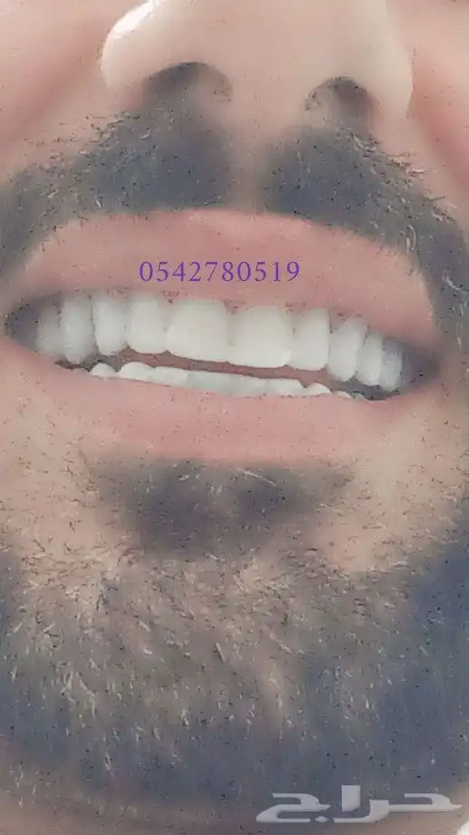 ابتسامة هوليود المتحركة 5