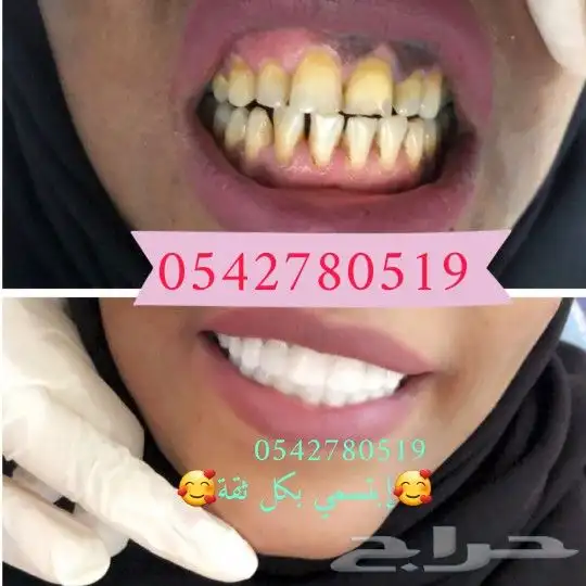 ابتسامة هوليود المتحركة 2