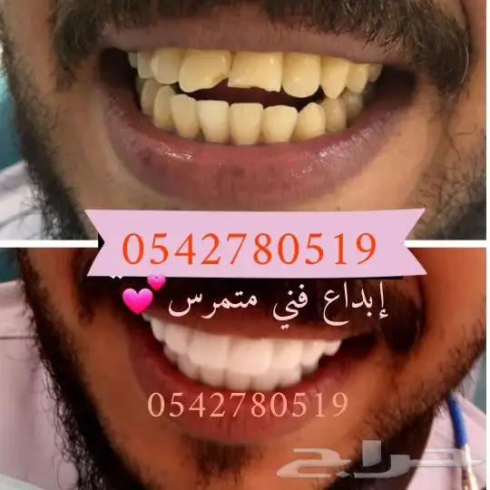 ابتسامة هوليود المتحركة 1