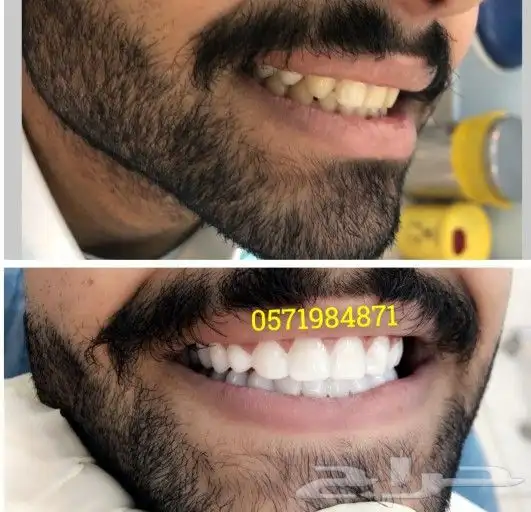 ابتسامة هوليود المتحركة 9