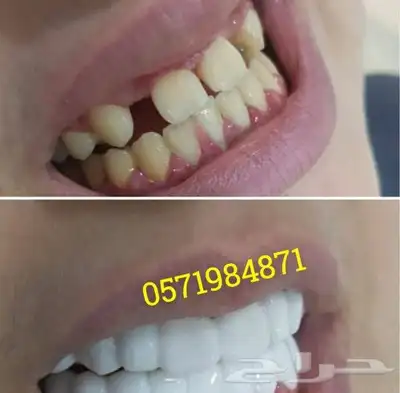 ابتسامة هوليود المتحركة 5
