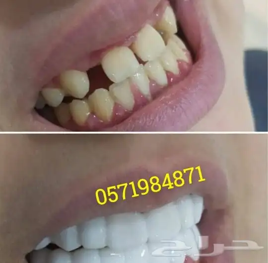 ابتسامة هوليود المتحركة 5