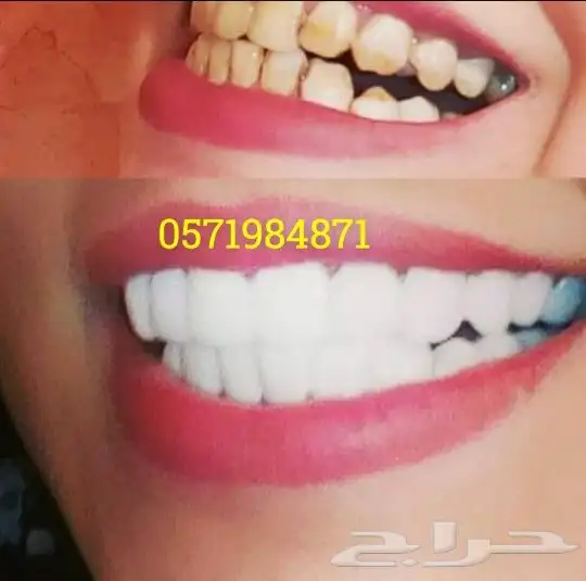 ابتسامة هوليود المتحركة 8