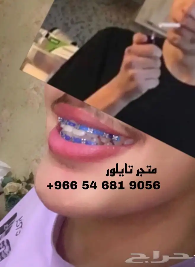 تقويم اسنان زينة تقويم اسنان زينه ب 39  عرض 3