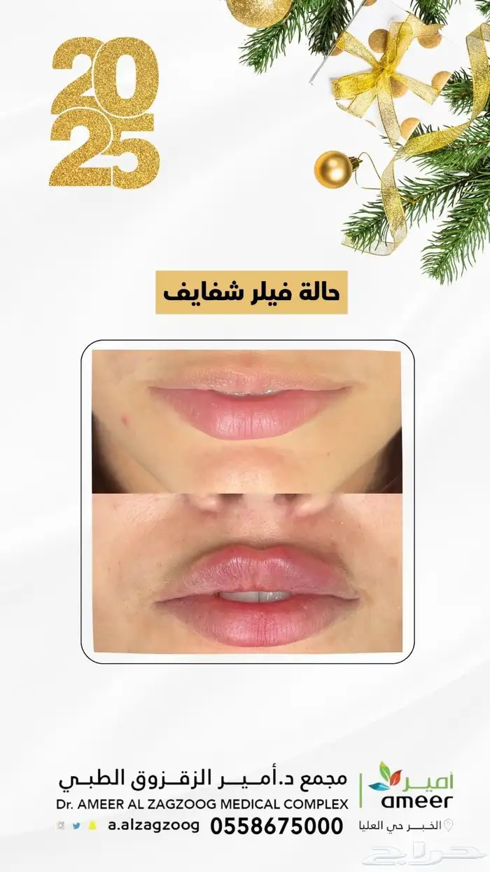 تجميل فيلر 2