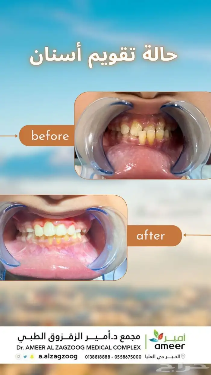 تجميل فيلر 1