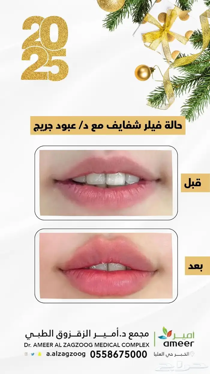 تجميل فيلر 0