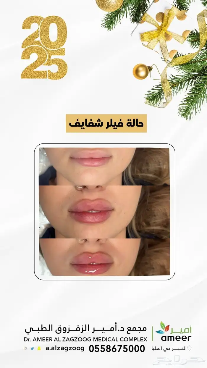 تجميل فيلر 3