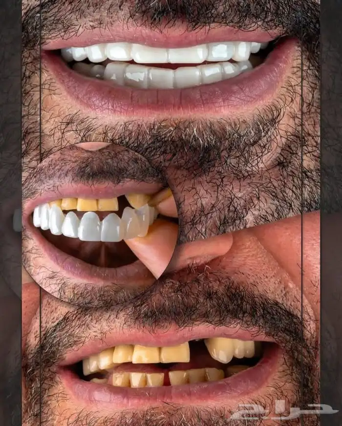 ابتسامة هوليود 2