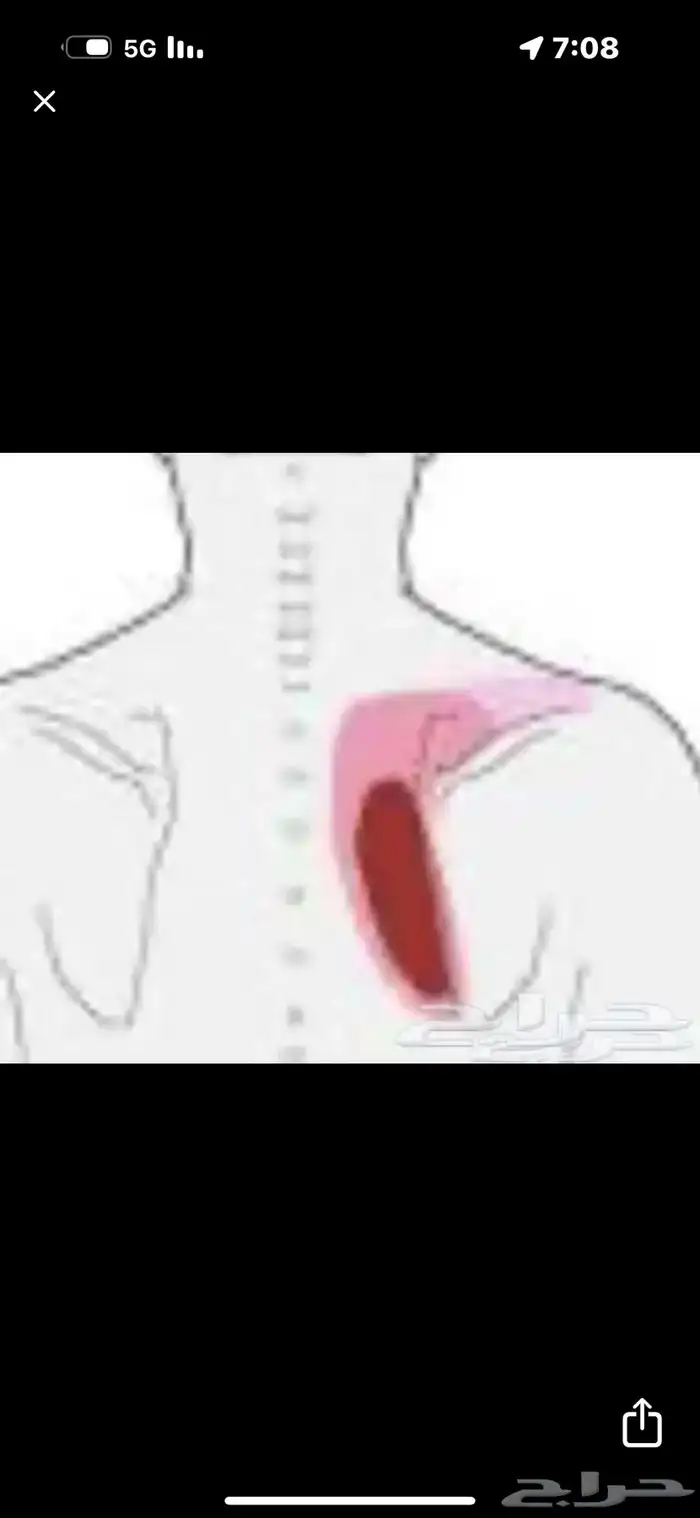طق الابهر وعلاجه 1