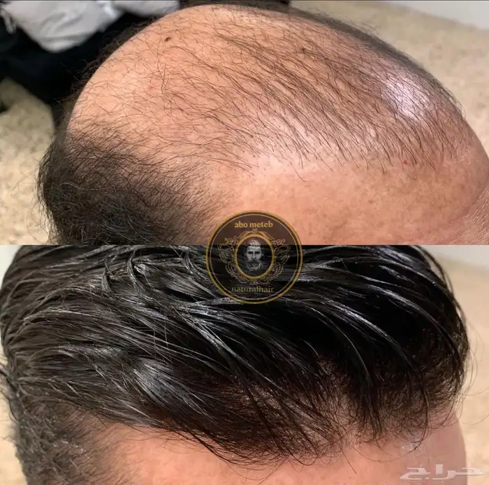 باروكة شعر (طبيعي) رجالي 1