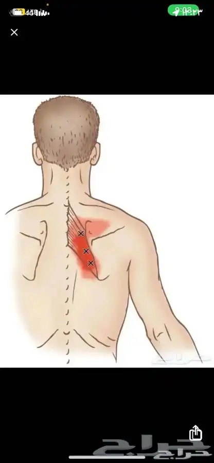 علاج الابهر وشقيقه 0