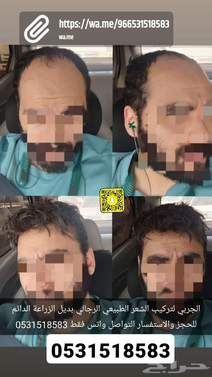 تركيب شعر رجالي بديل الزراعة 9
