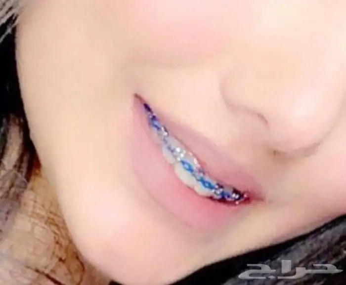 تقويم أسنان زينه 0