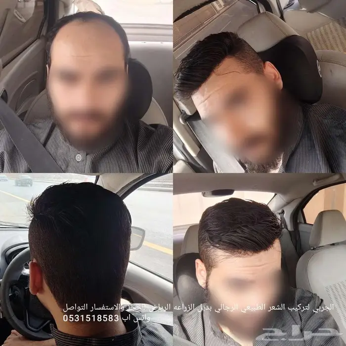 تركيب شعر دائم الرياض 1