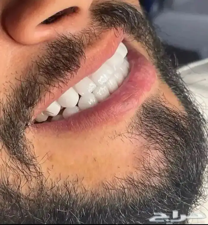 ابتسامة هوليود 2