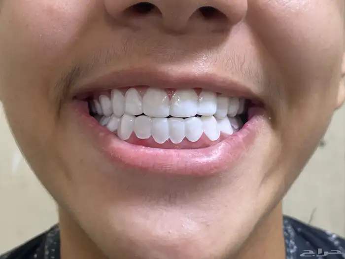 ايتسامة هوليود 4