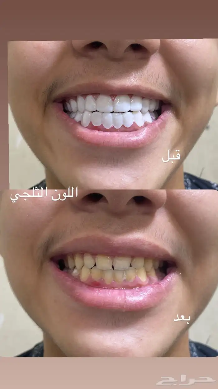 ايتسامة هوليود 1