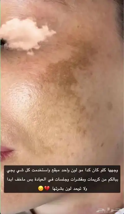 خلطه تبييض وصفاء وازاله الكلف نهااائي والنمش 2