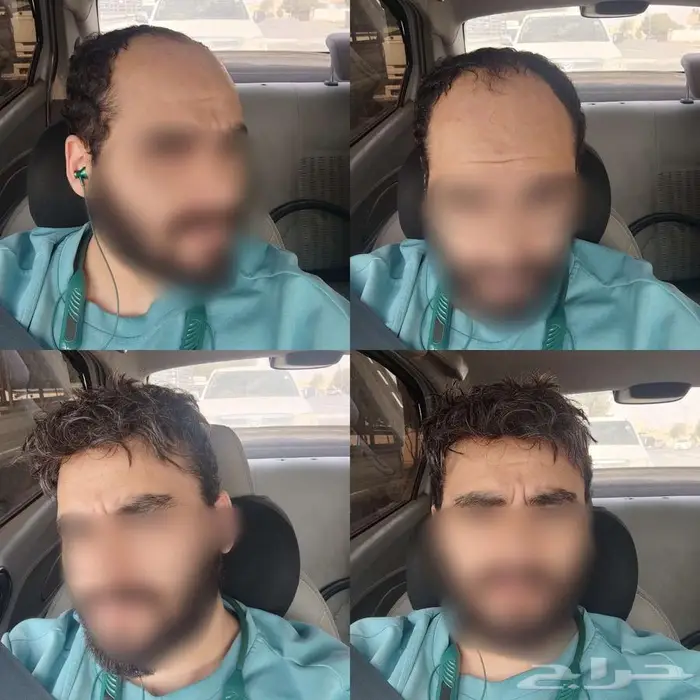 باروكة دائمة بديل الزراعة 11
