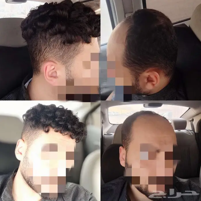 باروكة دائمة بديل الزراعة 8