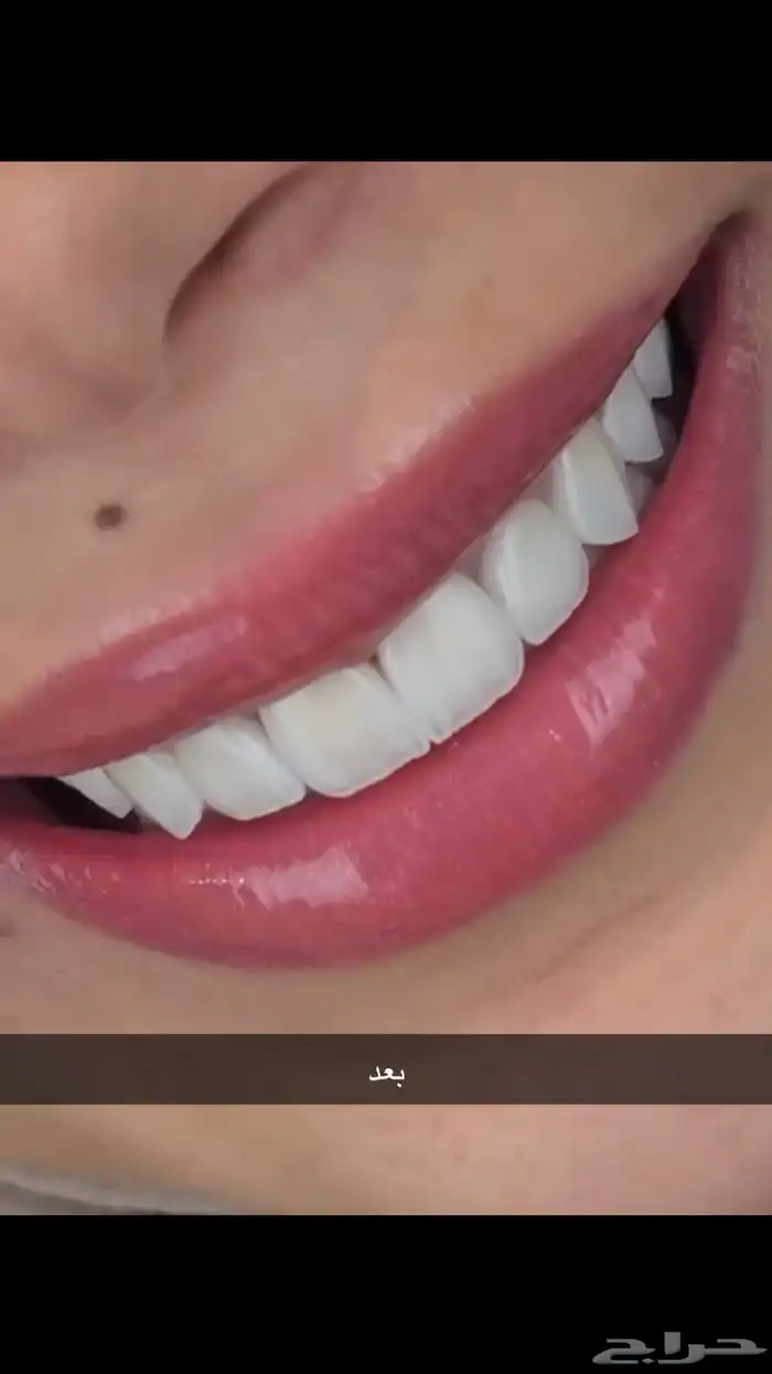 أبتسامه هوليود 1