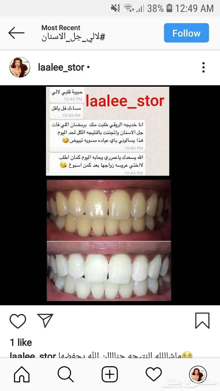 تبييض الاسنان 5