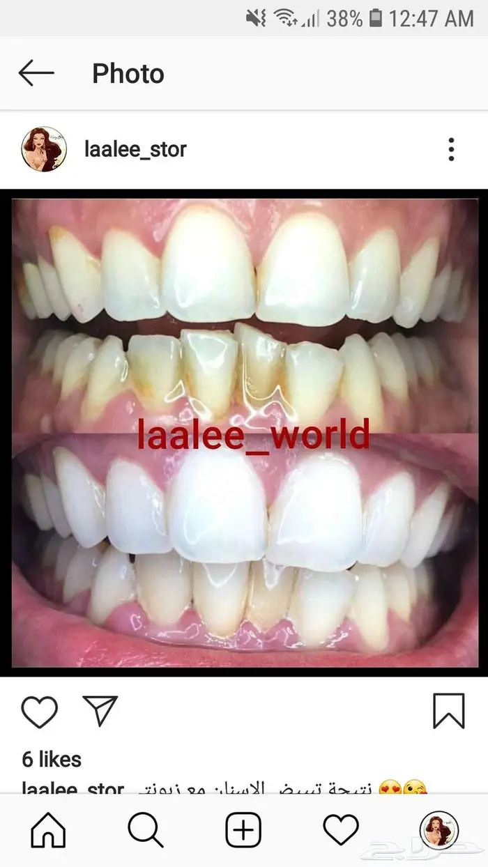 تبييض الاسنان 14