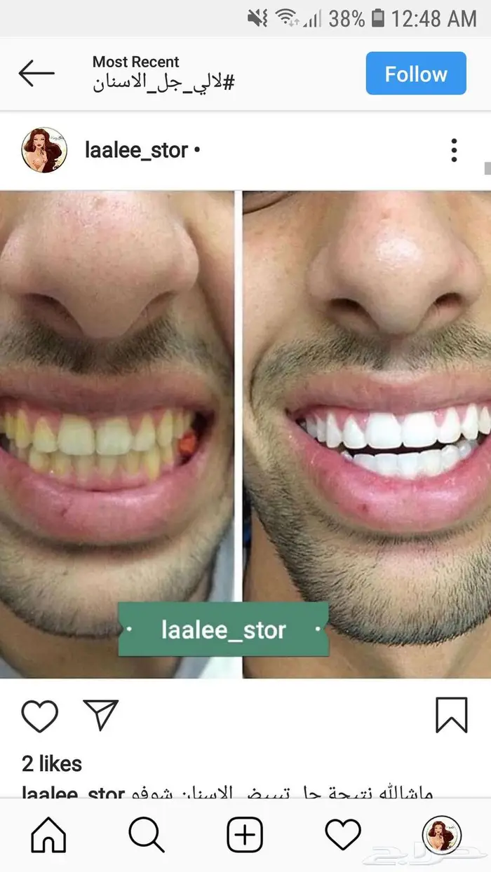 تبييض الاسنان 8