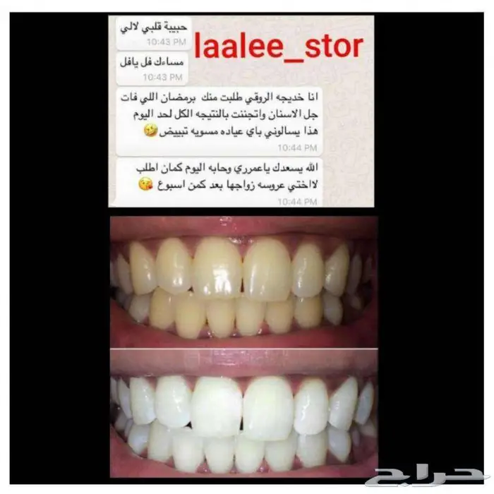 تبييض الاسنان 15