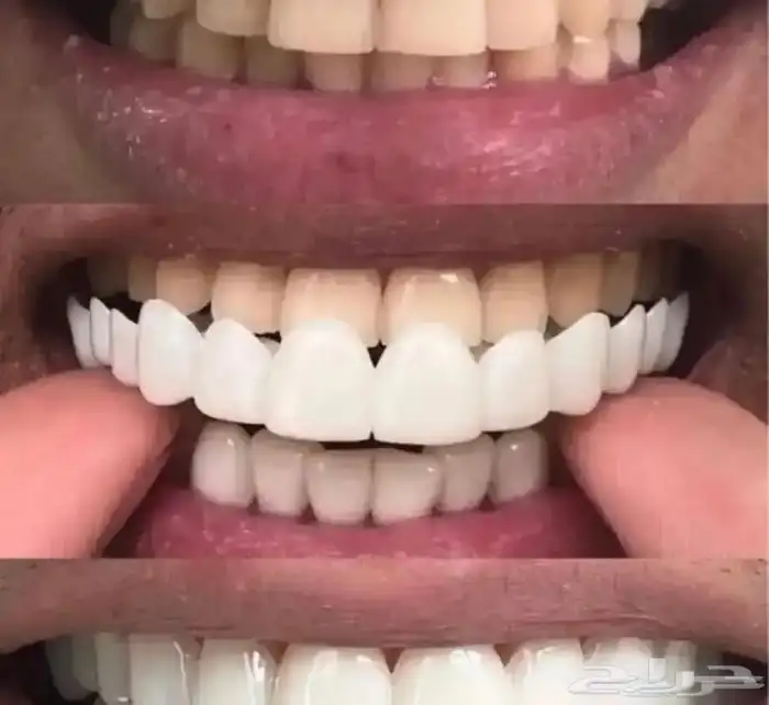عروض على ابتسامه هوليود المتحركه سناب اون سمايل متوفر اقساط 3