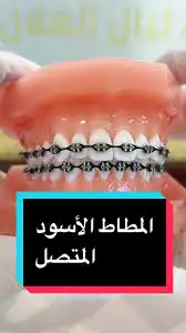 تقويم اسنان زينه 7