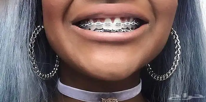 تقويم أسنان زينه 0