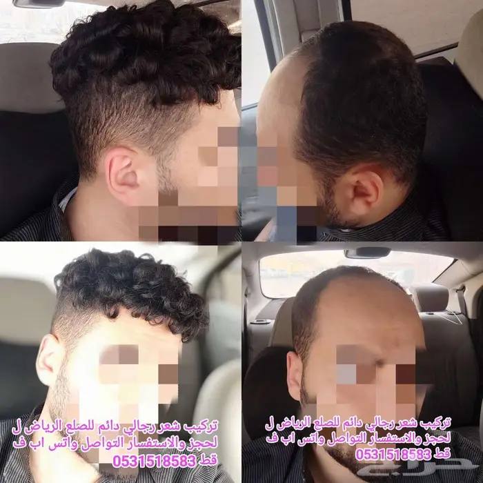 باروكة رجالي طبيعي لاصق دائم 3