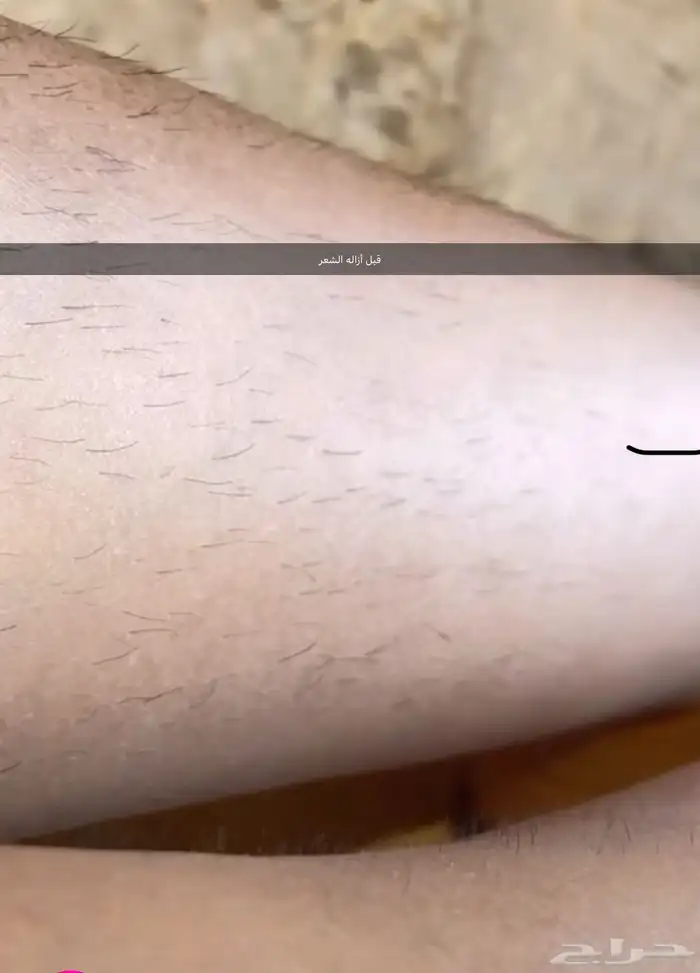 ليزر ازالة الشعر ملاي t3 1