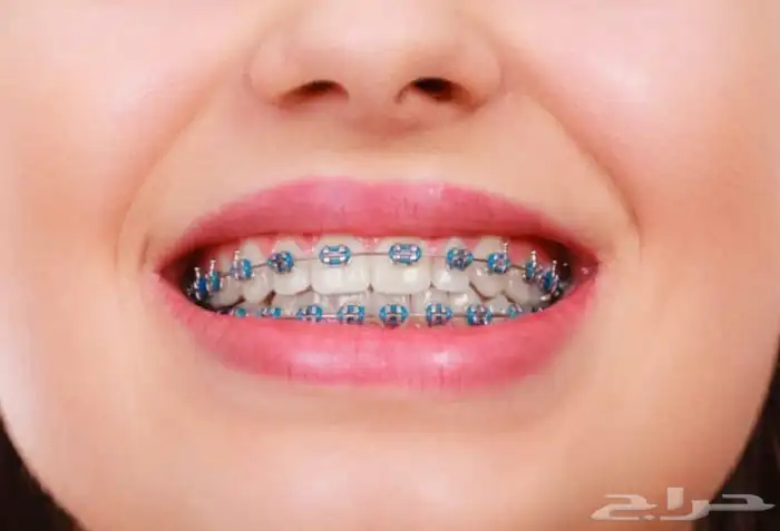 تقويم أسنان زينه 0