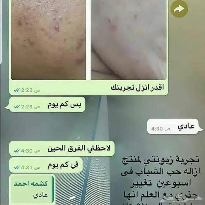 البيع مجموعة القضاء على حب الشباب 3