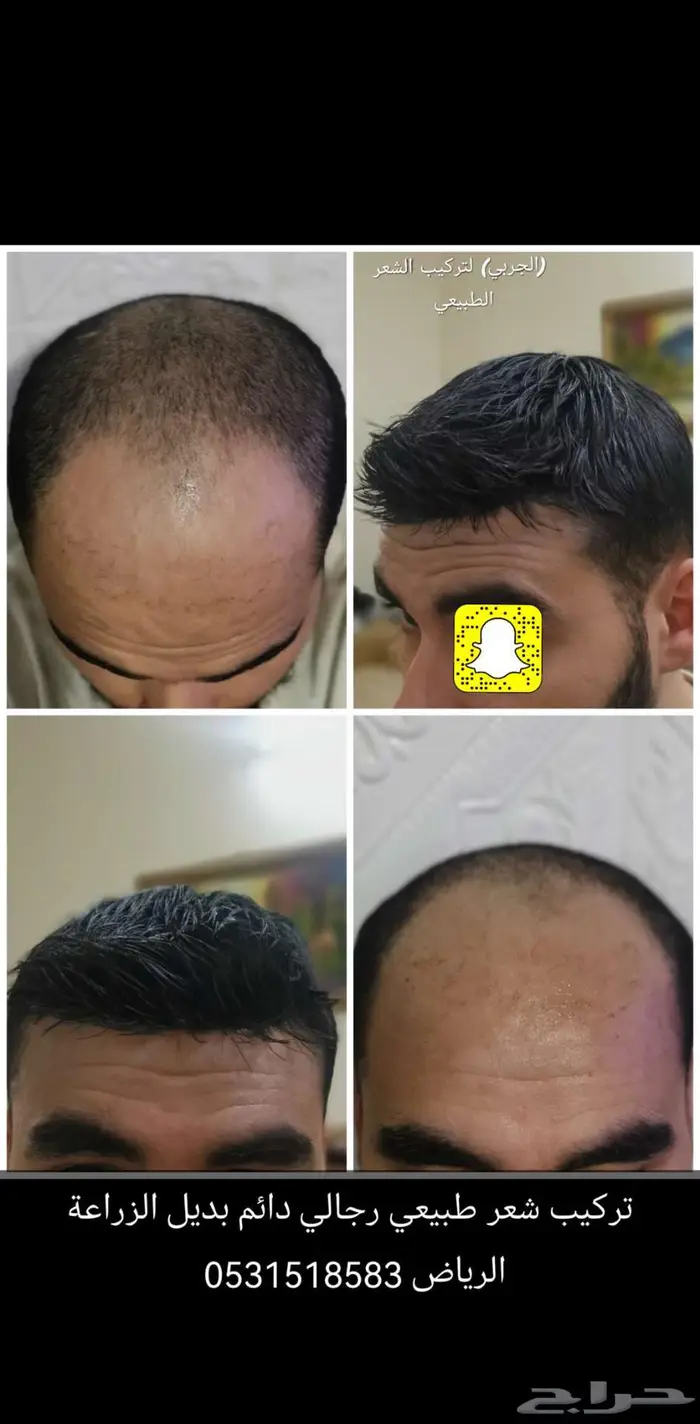 بوستيجة تركيب شعر رجالي 4