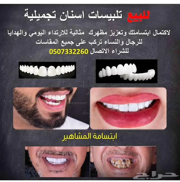 للبيع تلبيسات اسنان تجميلية 0