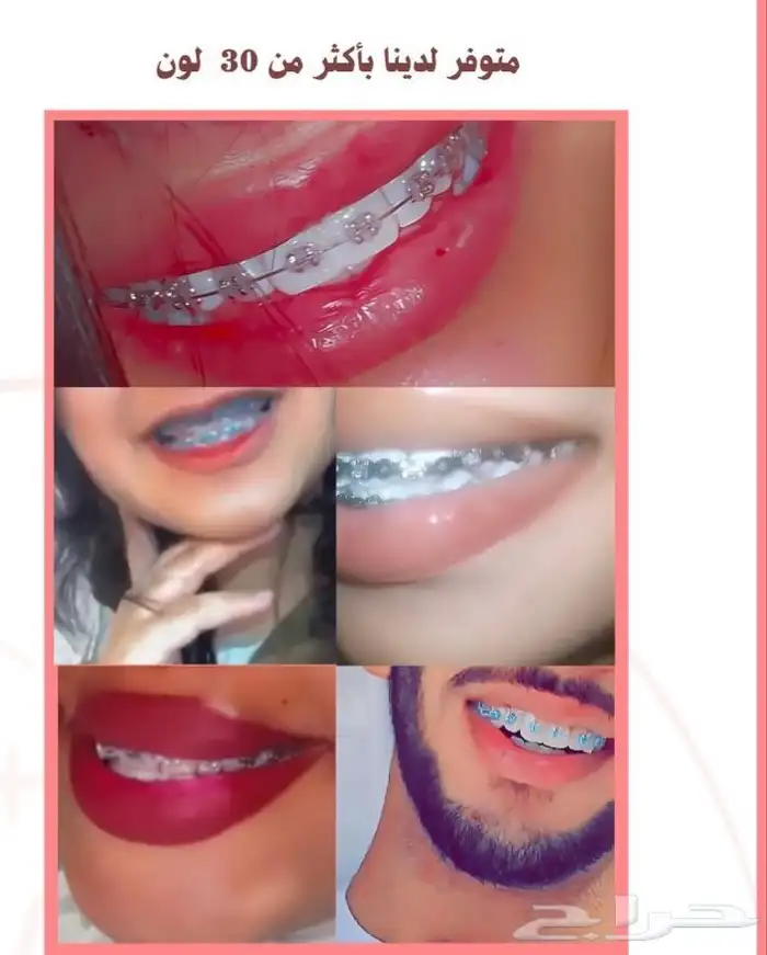 للبيع تقويم اسنان زينه 9